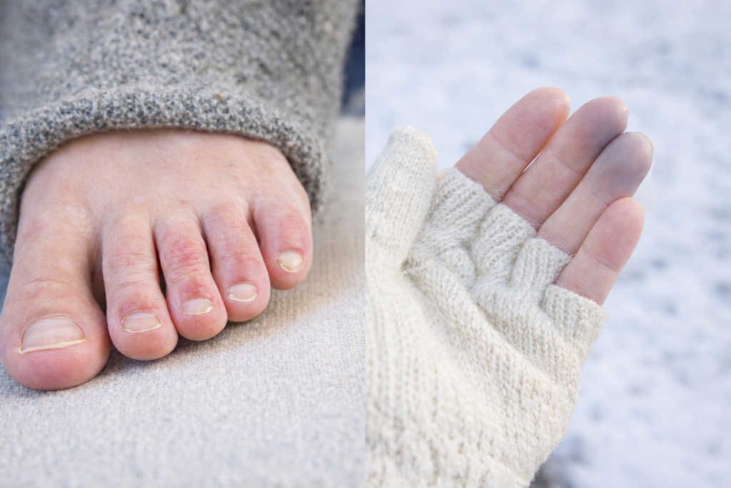 Cuidado de los pies en invierno: sabañones y síndrome de Raynaud